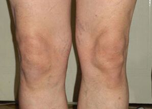 Osteflex-ի օգտագործման կուրսից հետո հոդերը վերադառնում են նորմալ